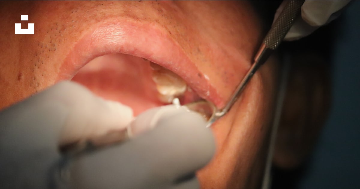 Are Cavity Fillings Really Necessary? — Dentacare dental guidance
