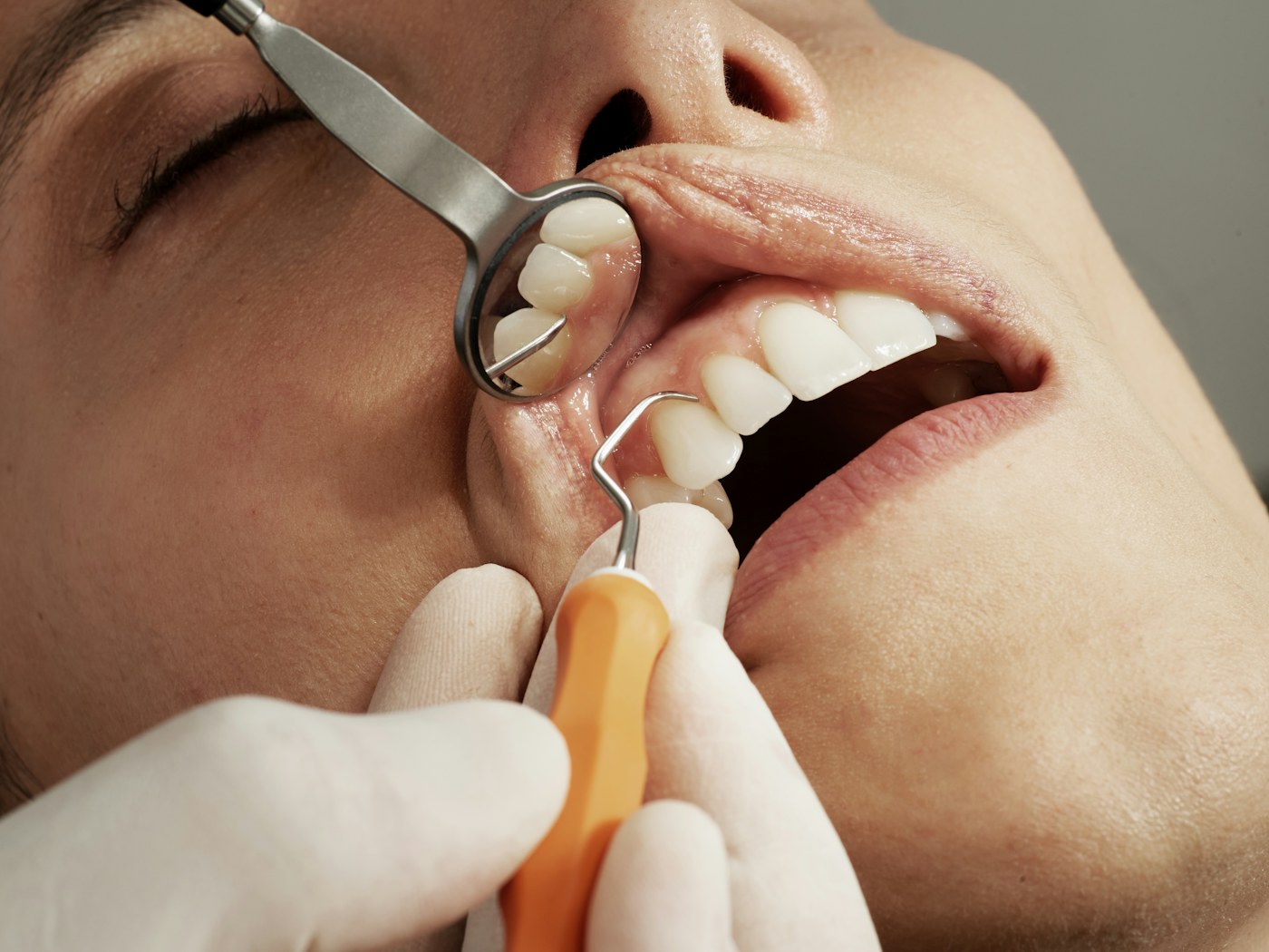 How to Get Rid of Cavities — Dentacare dental guidance