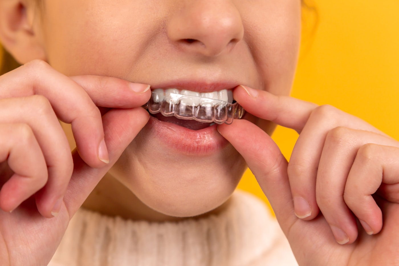 Cracked Teeth, Gaps or Discoloration? Veneers and Alternatives — Dentacare dental guidance