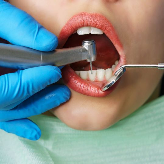 Oral Prophylaxis Services in Bilekahalli | Denta Care