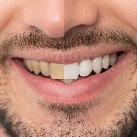 Teeth Whitening in Bilekahalli | Denta Care